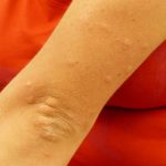 アトピー・花粉症・アレルギーのメカニズムと簡単なアレルギー対策